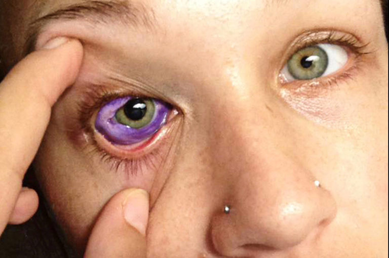 How To Treat Ingrown Eyelash (Trichiasis)? 4 Treatments