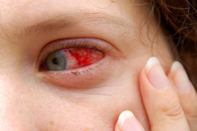 Symptoms Of Red Eye In Photo